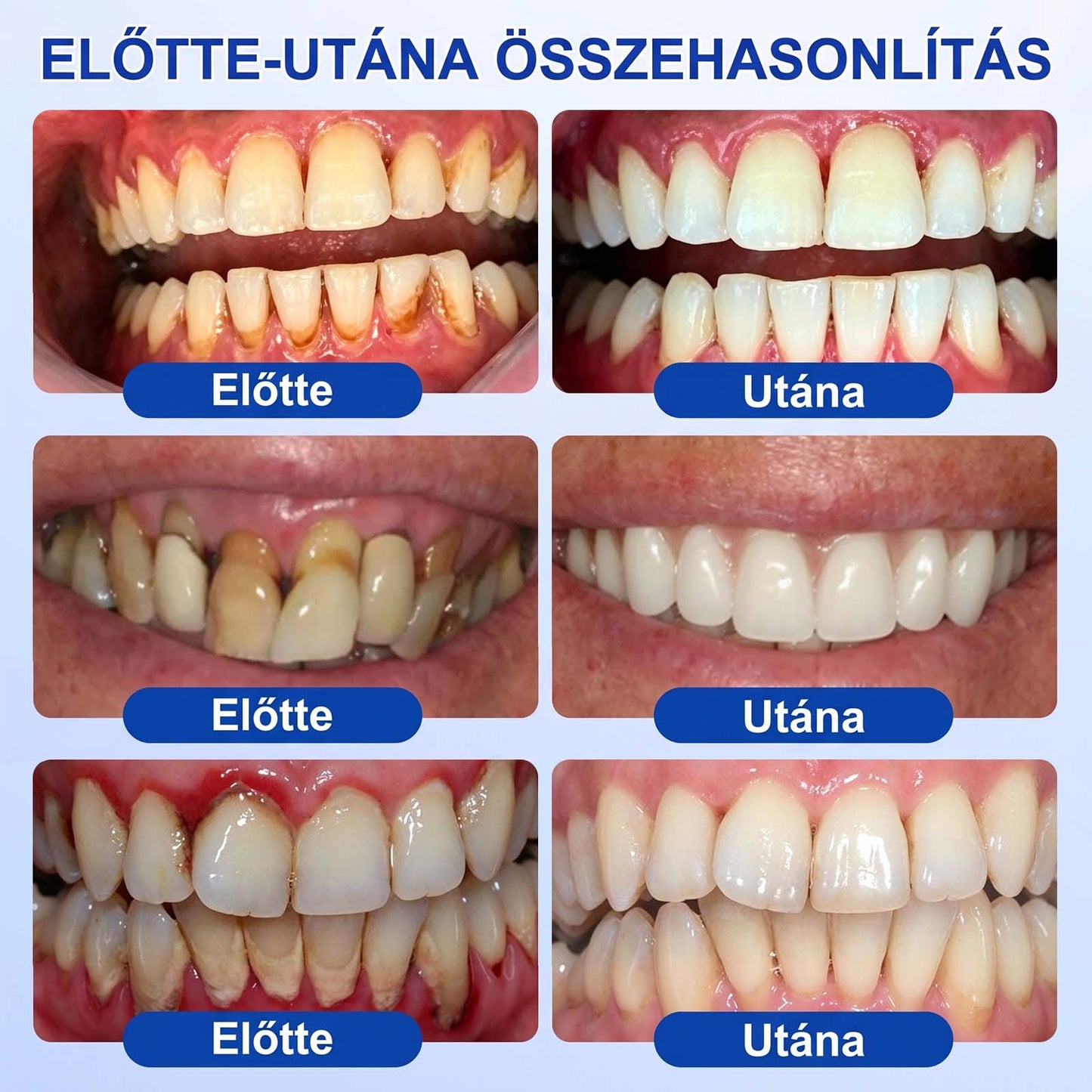 PureShade® 🦷🦷 GumRevive Ínyregeneráló Gél – Az egészségesebb ínyért és magabiztosabb mosolyért 👍
