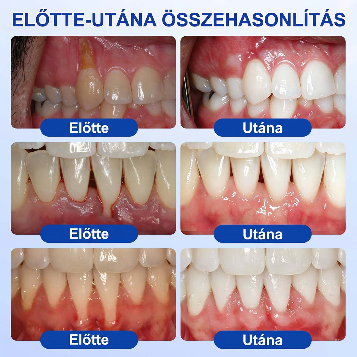 PureShade® 🦷🦷 GumRevive Ínyregeneráló Gél – Az egészségesebb ínyért és magabiztosabb mosolyért 👍