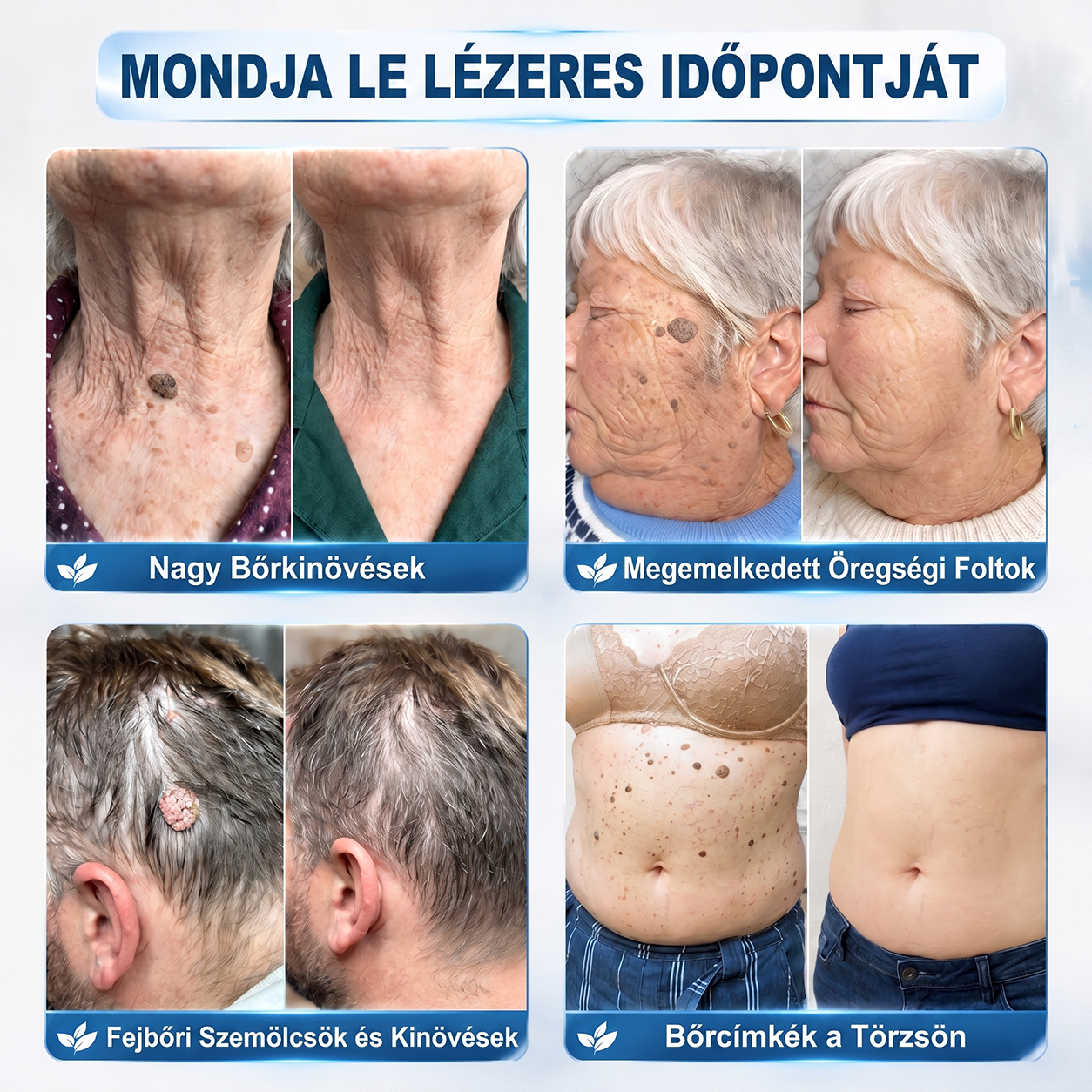 Hivatalos Márkabolt | 🚢 Hiskin® 7 napos Szemölcseltávolító Roll-on Ápoló Folyadék (Fájdalommentes rollerball technológia, hegek nélkül) 🐬
