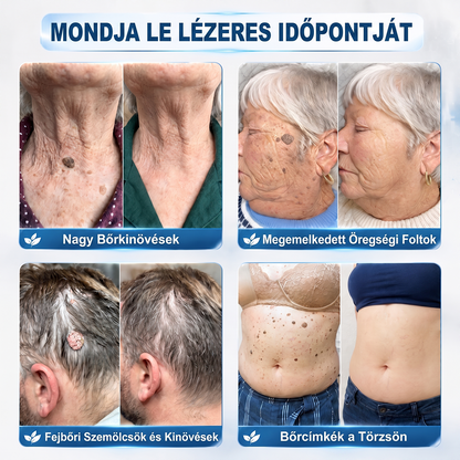 Hivatalos Márkabolt | 🚢 Hiskin® 7 napos Szemölcseltávolító Roll-on Ápoló Folyadék (Fájdalommentes rollerball technológia, hegek nélkül) 🐬