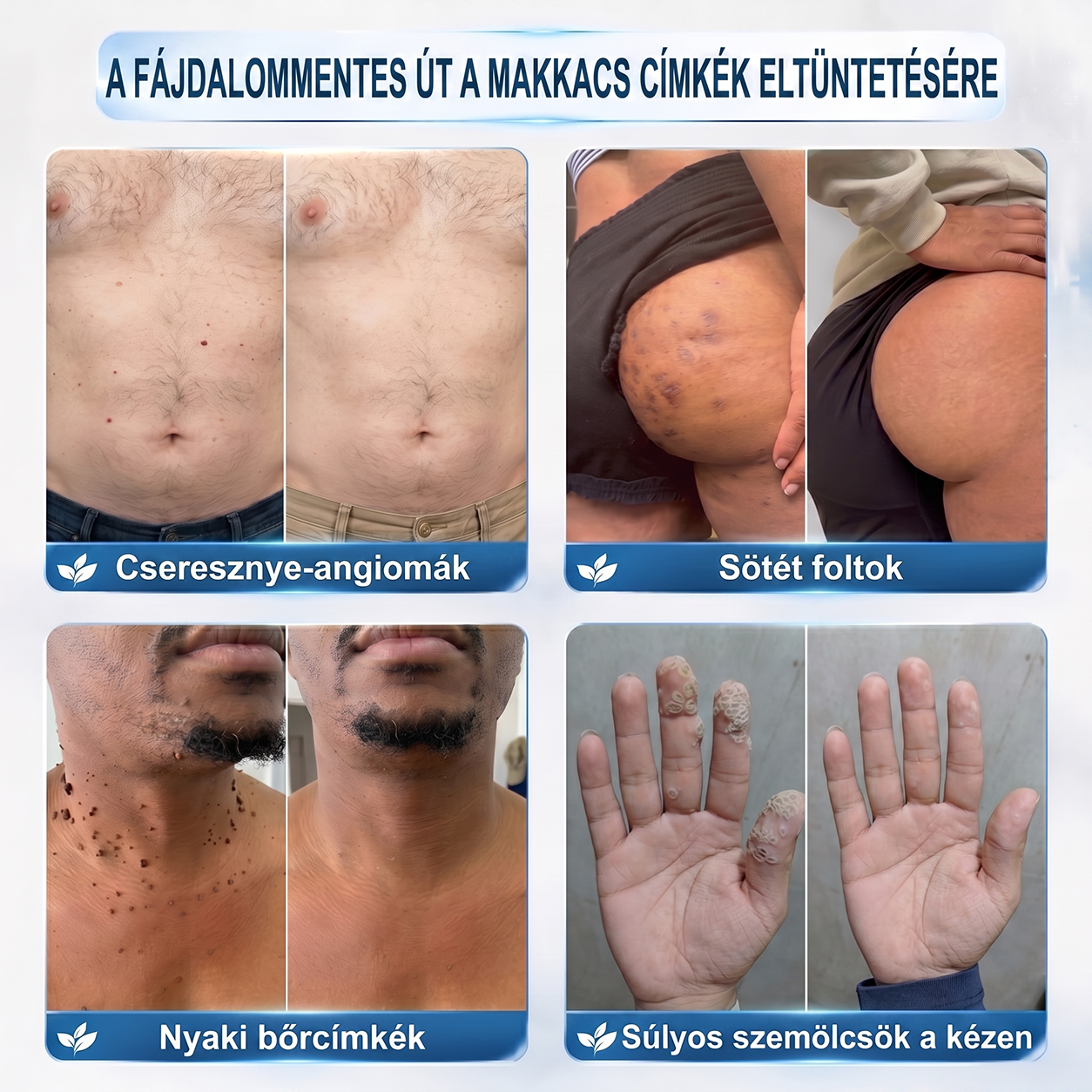 Hivatalos Márkabolt | 🚢 Hiskin® 7 napos Szemölcseltávolító Roll-on Ápoló Folyadék (Fájdalommentes rollerball technológia, hegek nélkül) 🐬