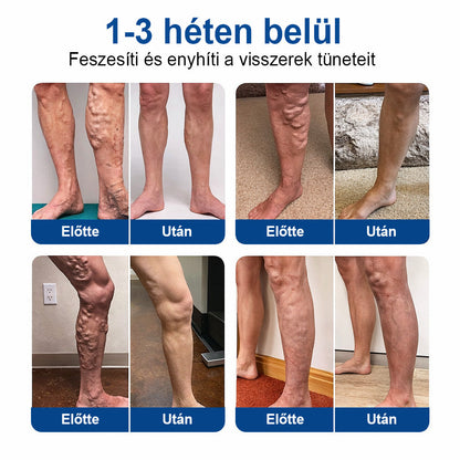 👩‍⚕️👩‍⚕️FFBSI® Visszérápoló Mikrotűs Gondozó Tapasz ⚡ Azonnali Megkönnyebbülés, Hosszú Távú Eredmények