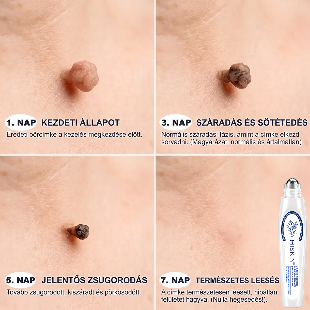 Hivatalos Márkabolt | 🚢 Hiskin® 7 napos Szemölcseltávolító Roll-on Ápoló Folyadék (Fájdalommentes rollerball technológia, hegek nélkül) 🐬