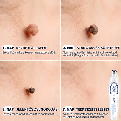Hivatalos Márkabolt | 🚢 Hiskin® 7 napos Szemölcseltávolító Roll-on Ápoló Folyadék (Fájdalommentes rollerball technológia, hegek nélkül) 🐬