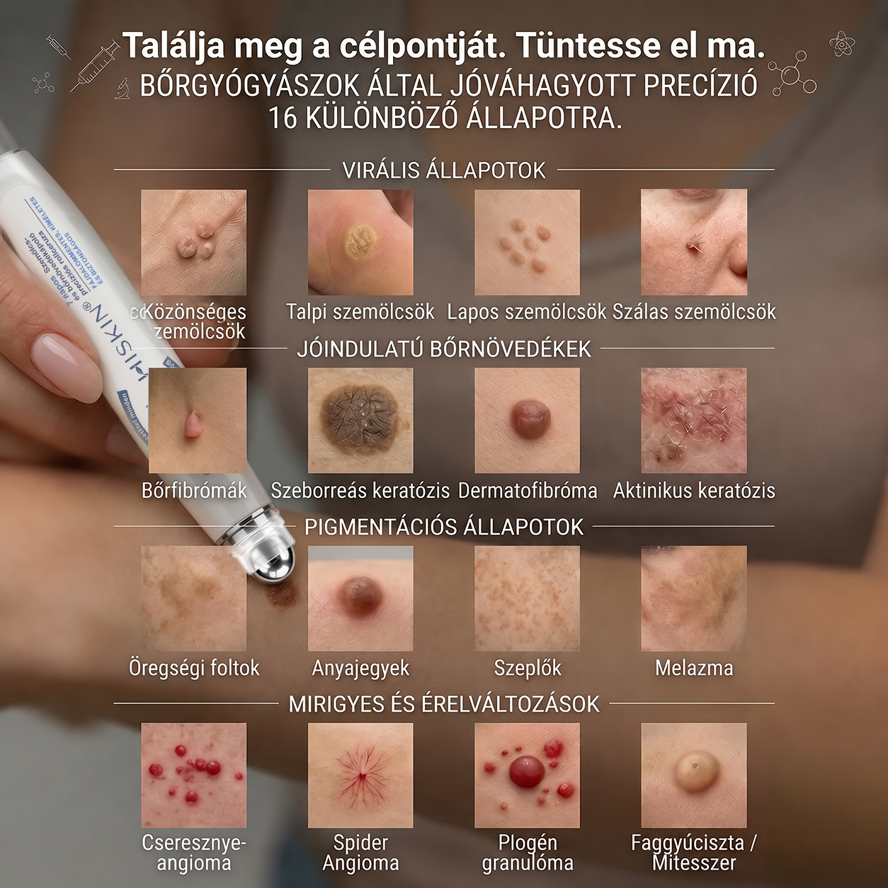 Hivatalos Márkabolt | 🚢 Hiskin® 7 napos Szemölcseltávolító Roll-on Ápoló Folyadék (Fájdalommentes rollerball technológia, hegek nélkül) 🐬