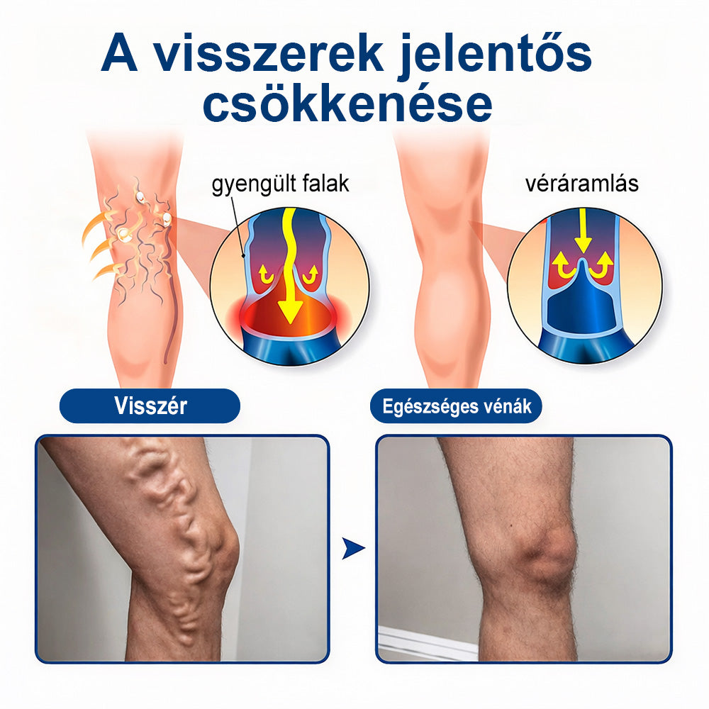 👩‍⚕️👩‍⚕️FFBSI® Visszérápoló Mikrotűs Gondozó Tapasz ⚡ Azonnali Megkönnyebbülés, Hosszú Távú Eredmények